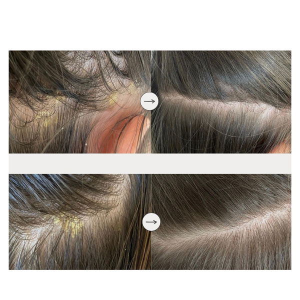 Mediceuticals Zestaw kosmetyk&oacute;w Dandruff (X-Folate&trade; 250ml, Therapeutic&trade; 250ml, TheraRx&trade; 250ml) 54010 zdjęcia